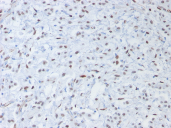 Formalin-fixed, paraffin embedded human testis sections stained with 100 ul anti-Wilm s Tumor 1 (clone rWT1/857) at 1:400. HIER epitope retrieval prior to staining was performed in 10mM Citrate, pH 6.0.